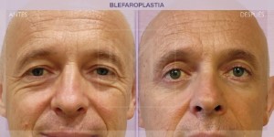 Before and after image of a eye lift procedure.